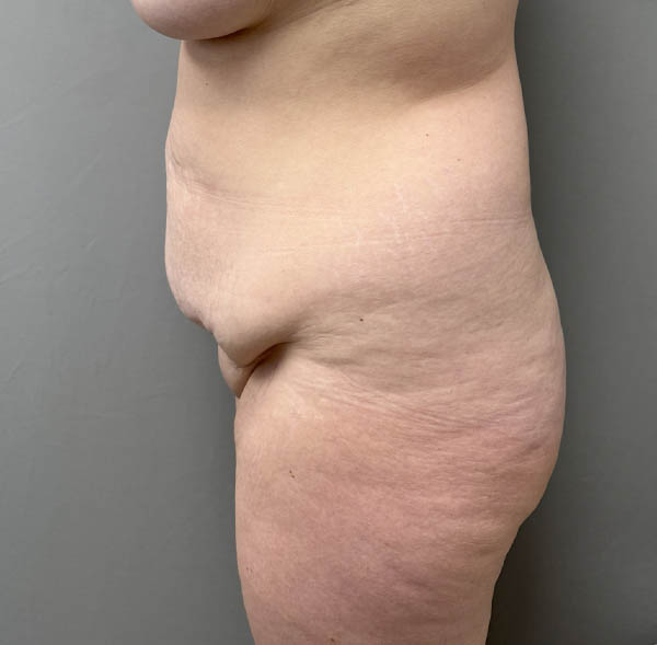 Tummy Tuck
