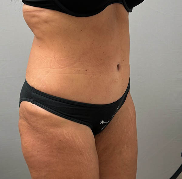 Tummy Tuck