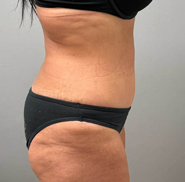 Tummy Tuck