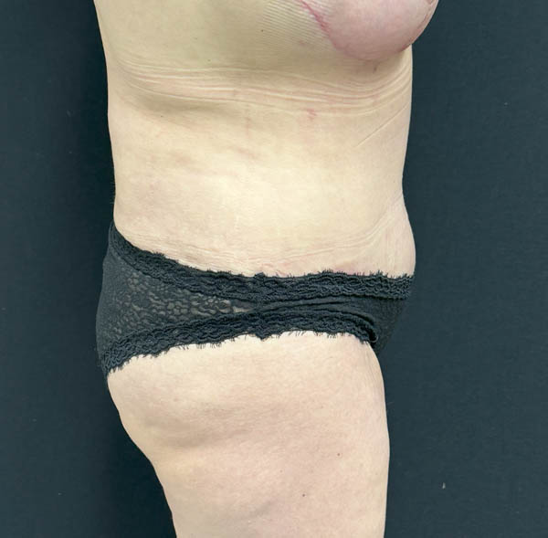 Tummy Tuck