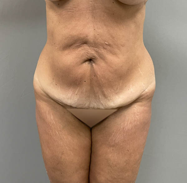 Tummy Tuck