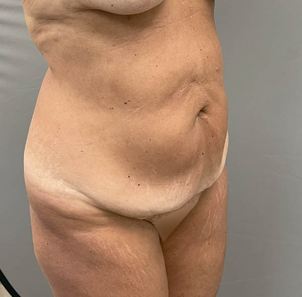 Tummy Tuck