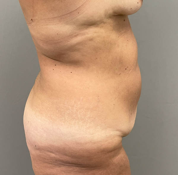 Tummy Tuck