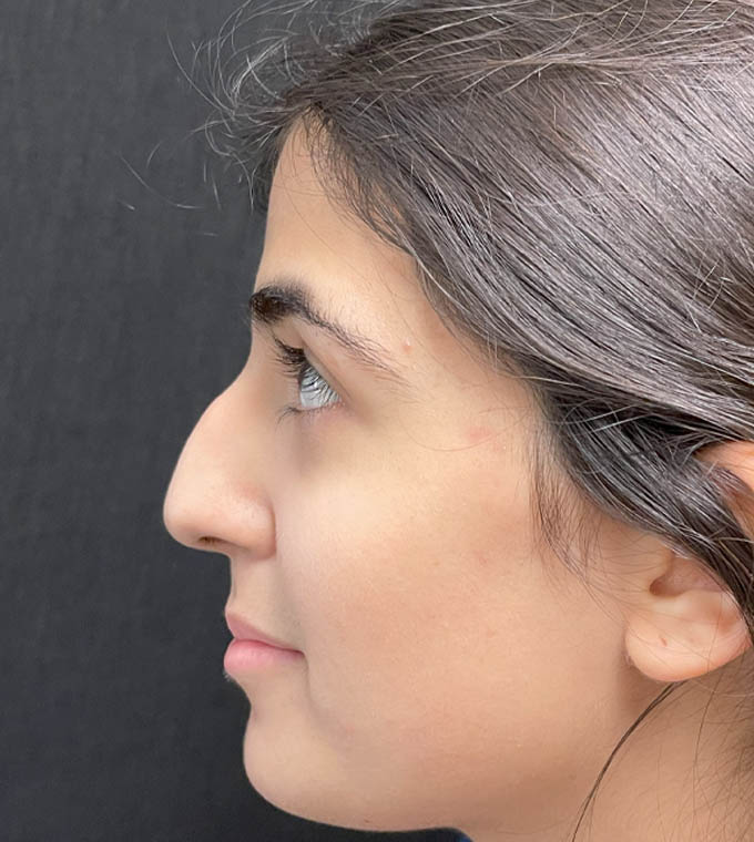 Rhinoplasty