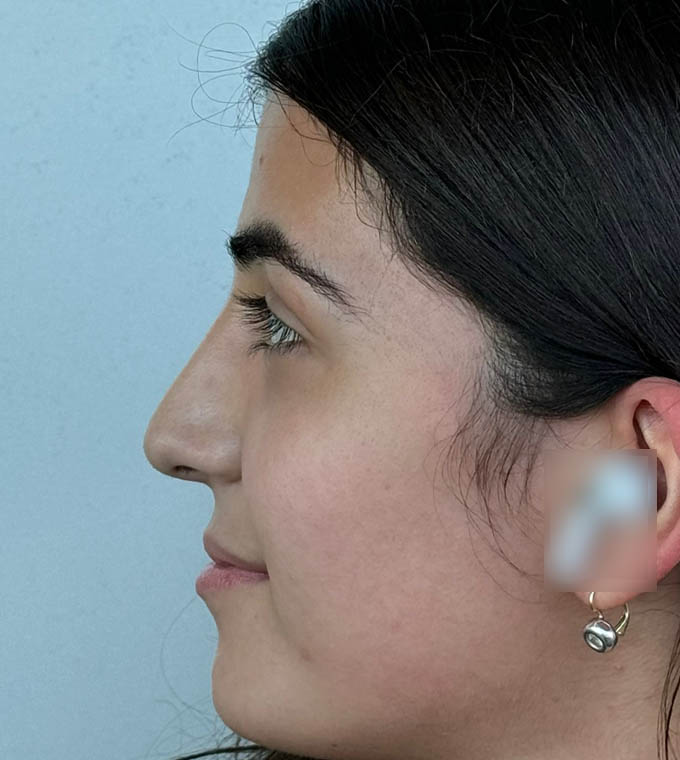 Rhinoplasty