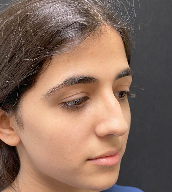Rhinoplasty