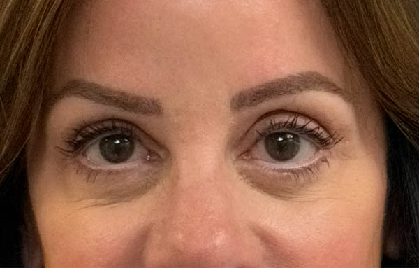 Blepharoplasty