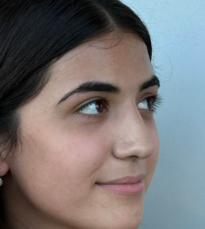 Rhinoplasty