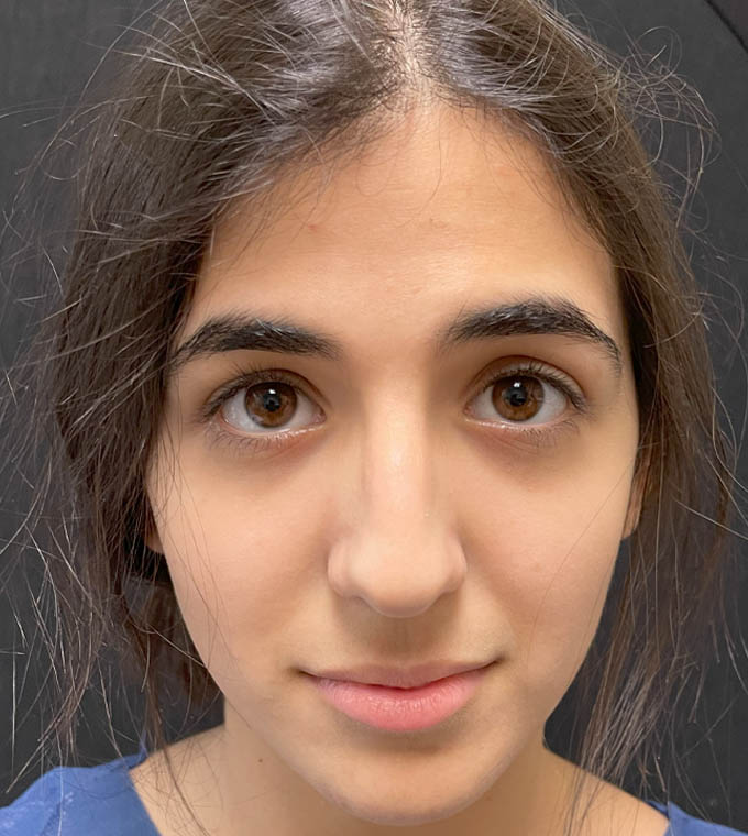 Rhinoplasty