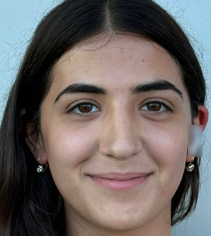 Rhinoplasty