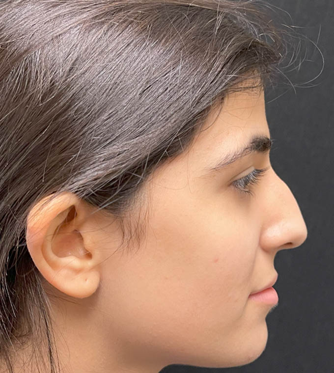 Rhinoplasty