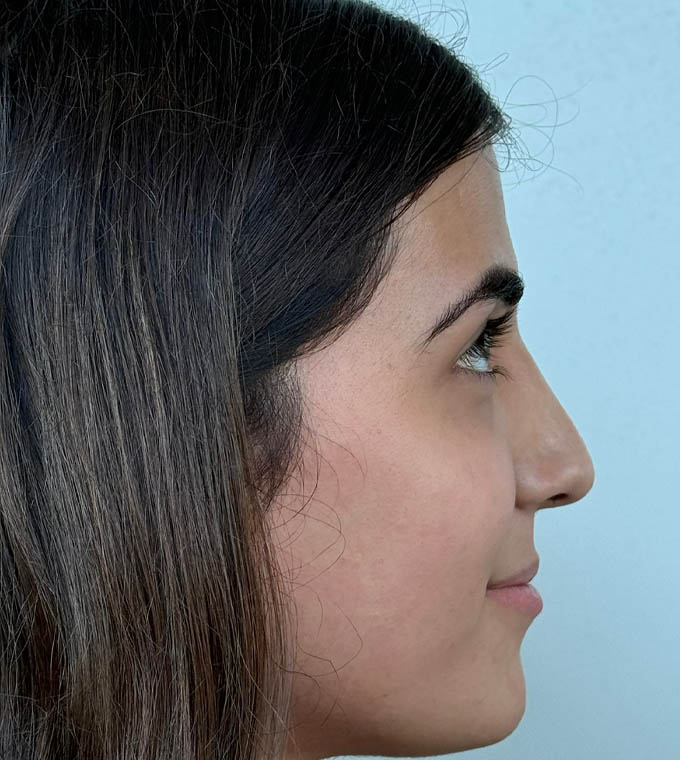 Rhinoplasty