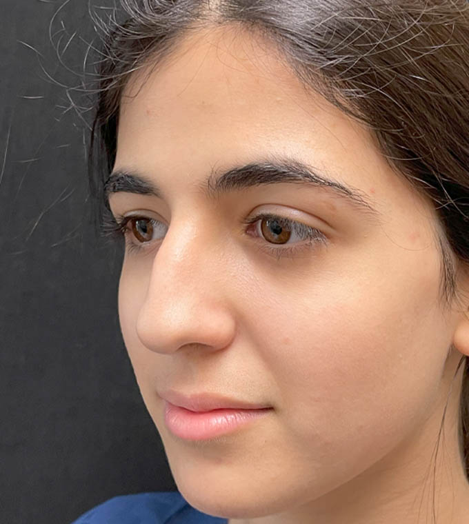Rhinoplasty