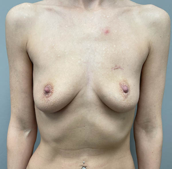 Breast Augmentation