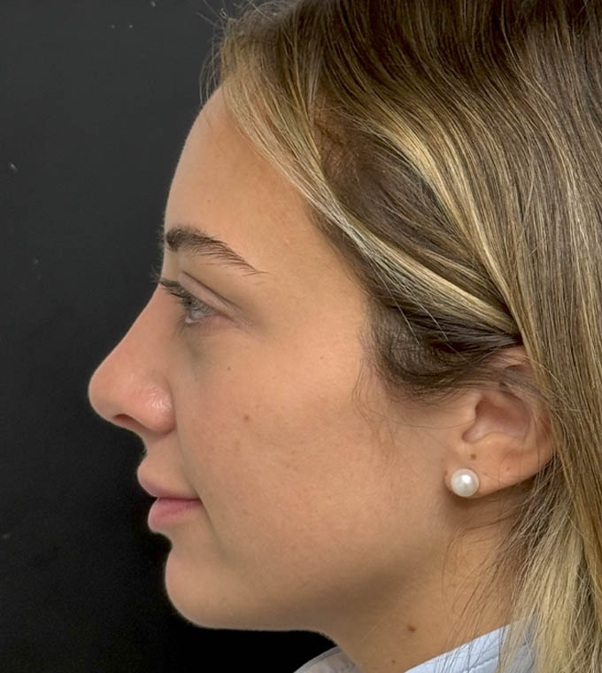 Rhinoplasty