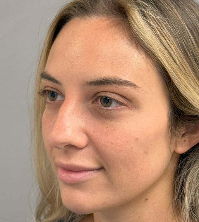 Rhinoplasty