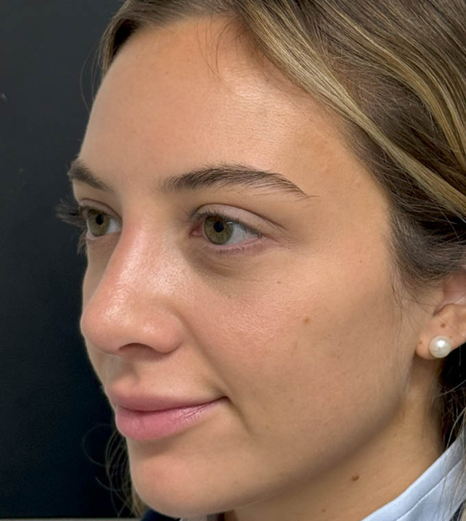 Rhinoplasty