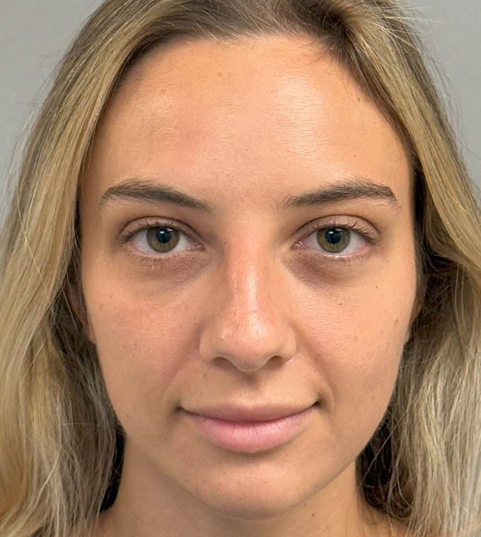 Rhinoplasty