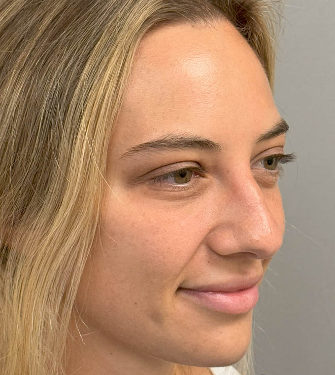 Rhinoplasty