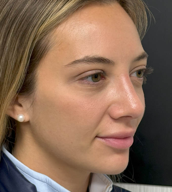 Rhinoplasty