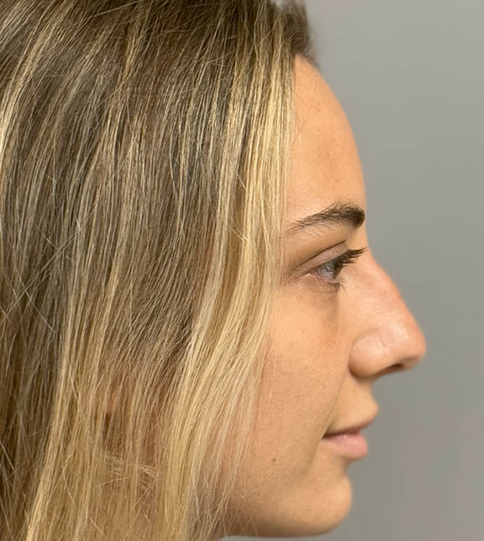 Rhinoplasty