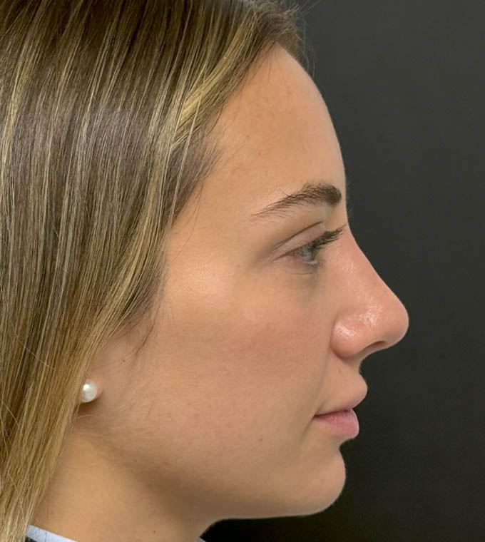 Rhinoplasty