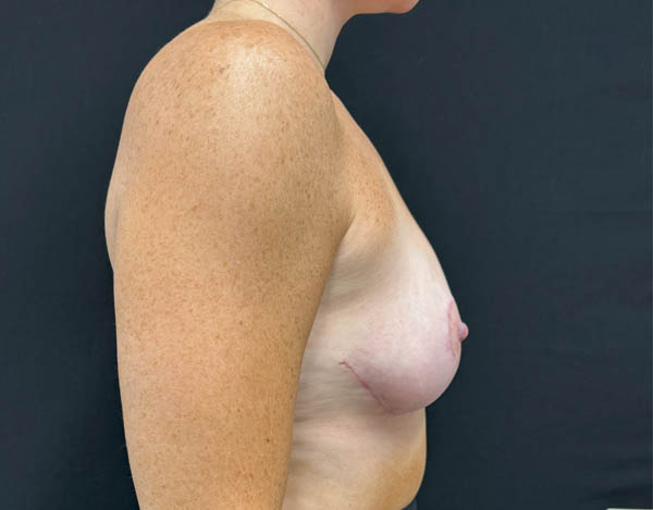 Breast Reduction