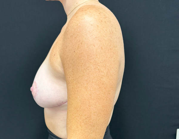 Breast Reduction