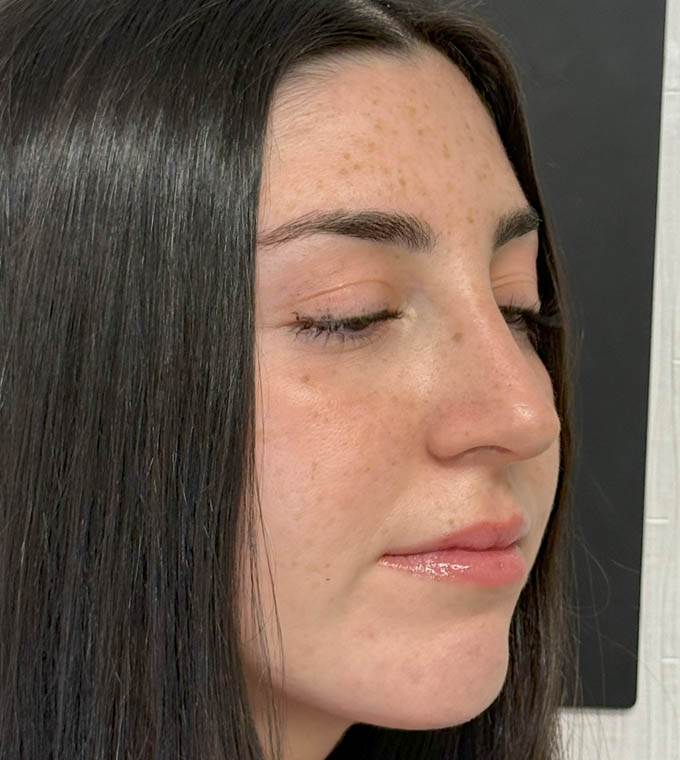 Rhinoplasty