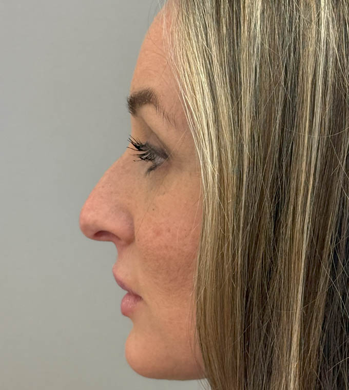 Rhinoplasty