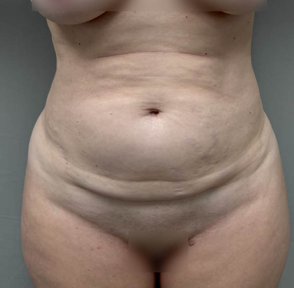 Tummy Tuck