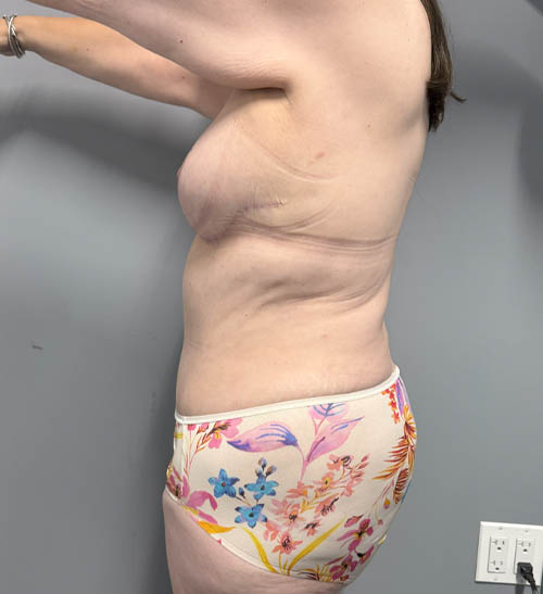 Mommy Makeover