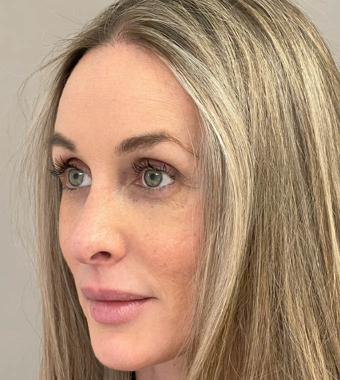 Rhinoplasty