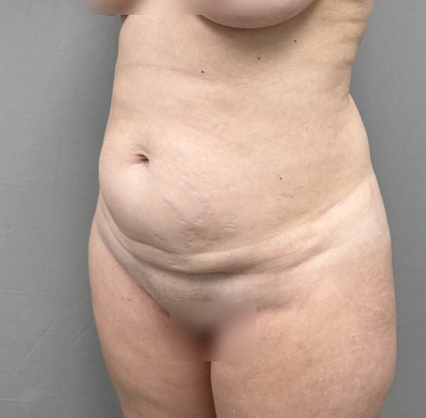 Tummy Tuck