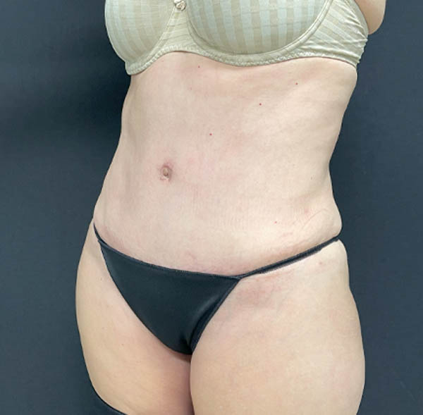 Tummy Tuck