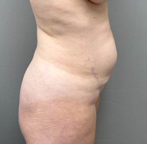 Tummy Tuck