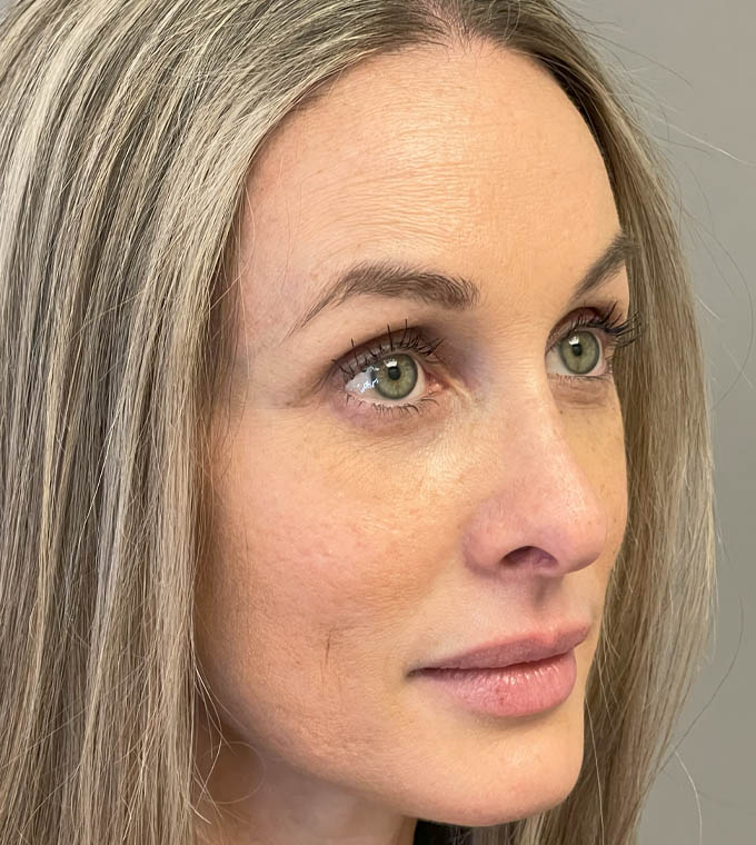 Rhinoplasty