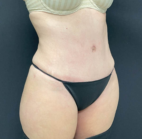 Tummy Tuck