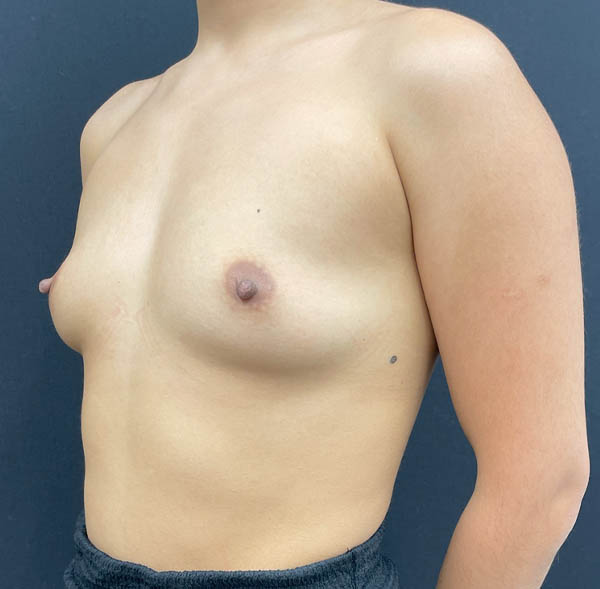 Breast Augmentation