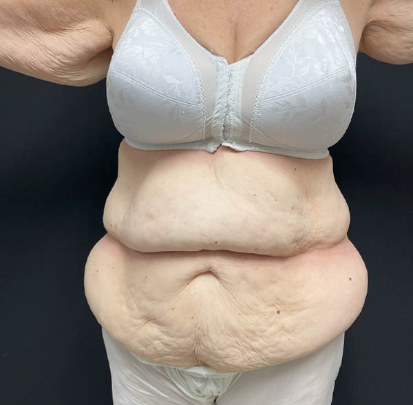 Tummy Tuck