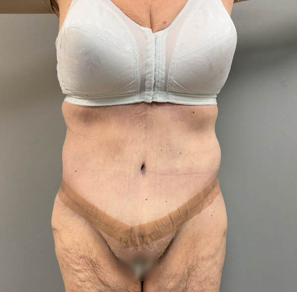 Tummy Tuck