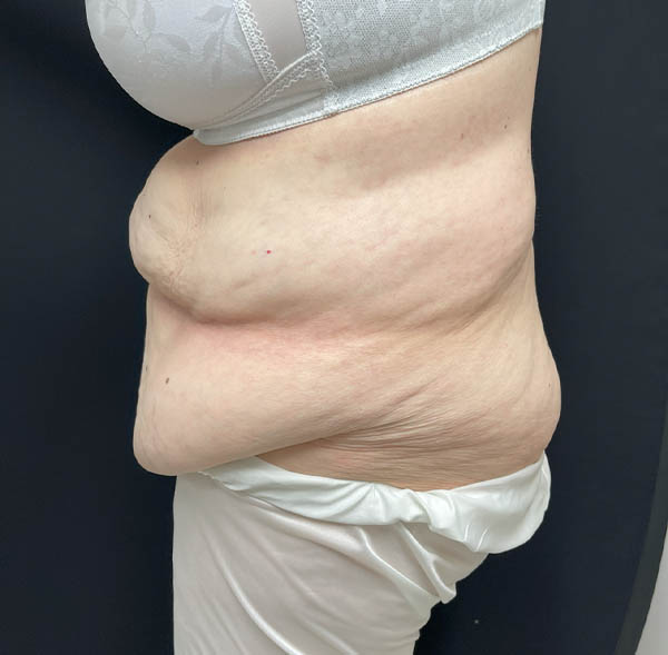 Tummy Tuck