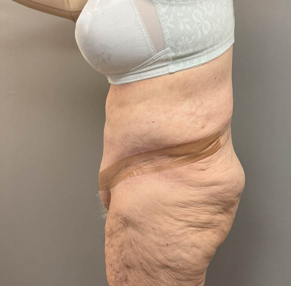 Tummy Tuck