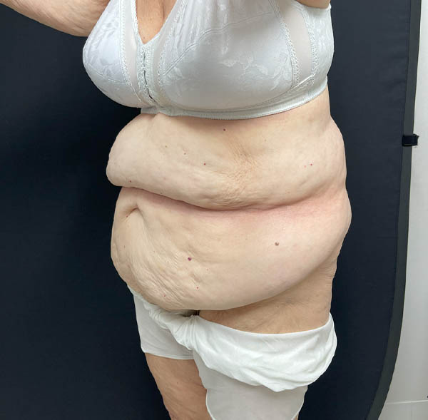 Tummy Tuck