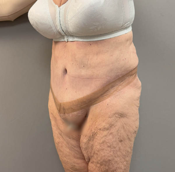 Tummy Tuck