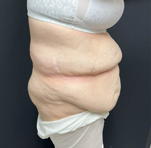 Tummy Tuck