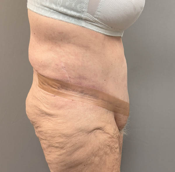 Tummy Tuck