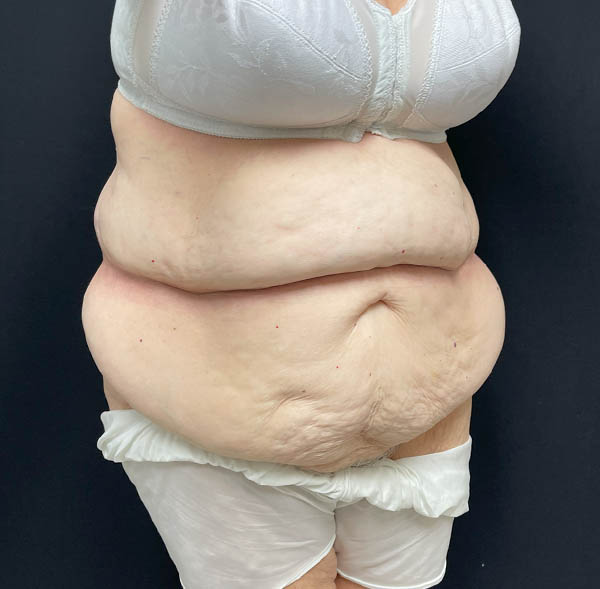 Tummy Tuck