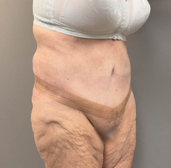 Tummy Tuck