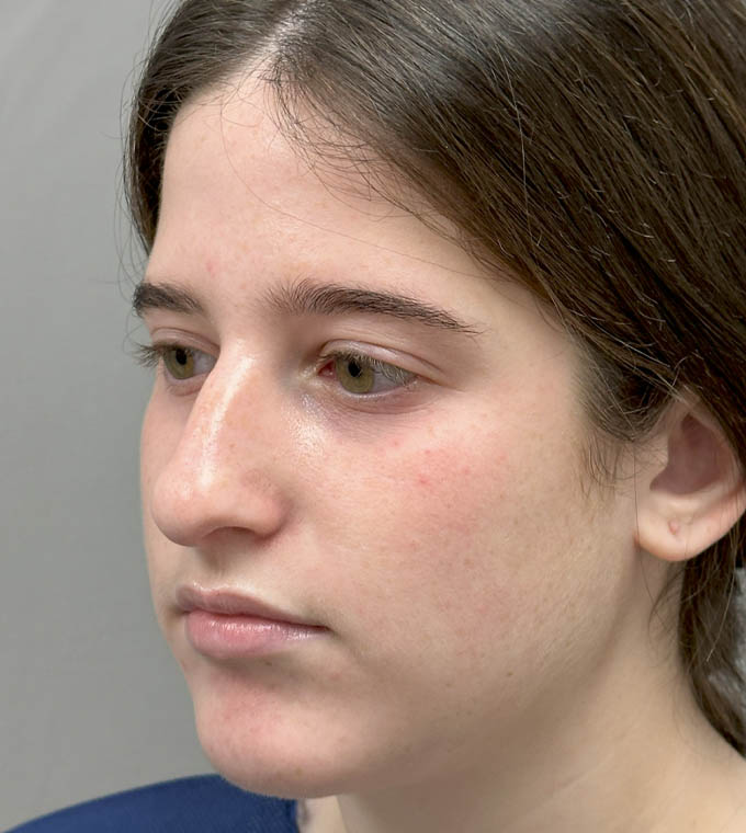 Rhinoplasty